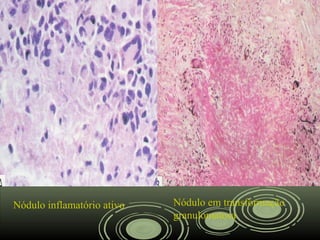 Nódulo inflamatório ativo Nódulo em transformação
granulomatosa
 