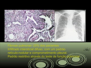 Fibrose pulmonar- 25% dos pacientes
Infiltrado intersticial difuso, com um padrão
retículo-nodular e comprometimento pleural.
Padrão restritivo através do teste de função pulmonar
 