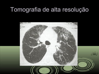 Tomografia de alta resoluçãoTomografia de alta resolução
 