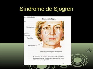 Síndrome de SjögrenSíndrome de Sjögren
 
