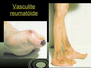 VasculiteVasculite
reumatóidereumatóide
 