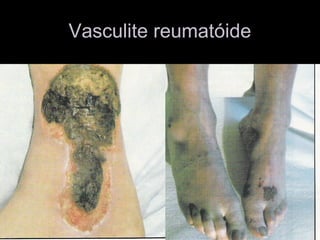 Vasculite reumatóideVasculite reumatóide
 
