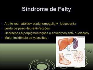 Síndrome de FeltySíndrome de Felty
 Artrite reumatóide+ esplenomegalia + leucopeniaArtrite reumatóide+ esplenomegalia + leucopenia
 perda de peso+febre+infecçõesperda de peso+febre+infecções
 ulcerações,hiperpigmentações e anticorpos anti- núcleares.ulcerações,hiperpigmentações e anticorpos anti- núcleares.
 Maior incidência de vasculitesMaior incidência de vasculites
 