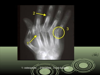 1- osteopenia 2-erosões 3-sub-luxação
 
