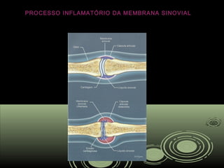 PROCESSO INFLAMATÓRIO DA MEMBRANA SINOVIAL
 