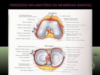 PROCESSO INFLAMATÓRIO DA MEMBRANA SINOVIAL
 
