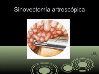 Sinovectomia artroscópicaSinovectomia artroscópica
 