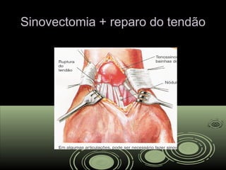 Sinovectomia + reparo do tendãoSinovectomia + reparo do tendão
 