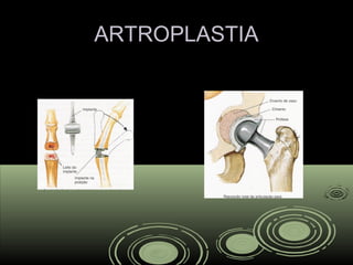ARTROPLASTIAARTROPLASTIA
 