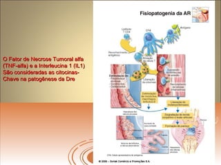 O Fator de Necrose Tumoral alfaO Fator de Necrose Tumoral alfa
(TNF-alfa) e a Interleucina 1 (IL1)(TNF-alfa) e a Interleucina 1 (IL1)
São consideradas as citocinas-São consideradas as citocinas-
Chave na patogênese da DreChave na patogênese da Dre
 