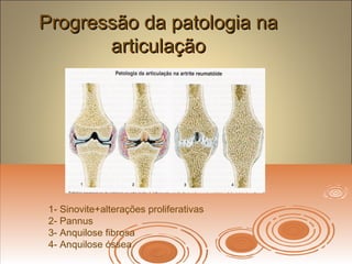 Progressão da patologia naProgressão da patologia na
articulaçãoarticulação
1- Sinovite+alterações proliferativas
2- Pannus
3- Anquilose fibrosa
4- Anquilose óssea
 