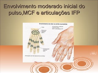 Envolvimento moderado inicial doEnvolvimento moderado inicial do
pulso,MCF e articulações IFPpulso,MCF e articulações IFP
 