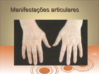 Manifestações articularesManifestações articulares
 