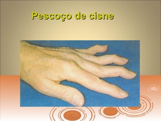 Pescoço de cisnePescoço de cisne
 