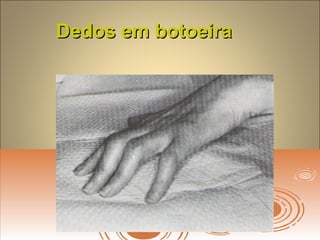 Dedos em botoeiraDedos em botoeira
 