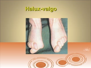 Halux-valgoHalux-valgo
 