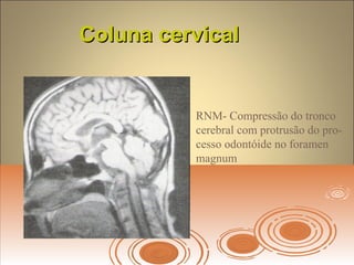 Coluna cervicalColuna cervical
RNM- Compressão do tronco
cerebral com protrusão do pro-
cesso odontóide no foramen
magnum
 