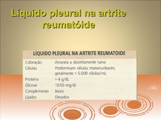 Líquido pleural na artriteLíquido pleural na artrite
reumatóidereumatóide
 