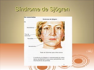 Síndrome de SjögrenSíndrome de Sjögren
 