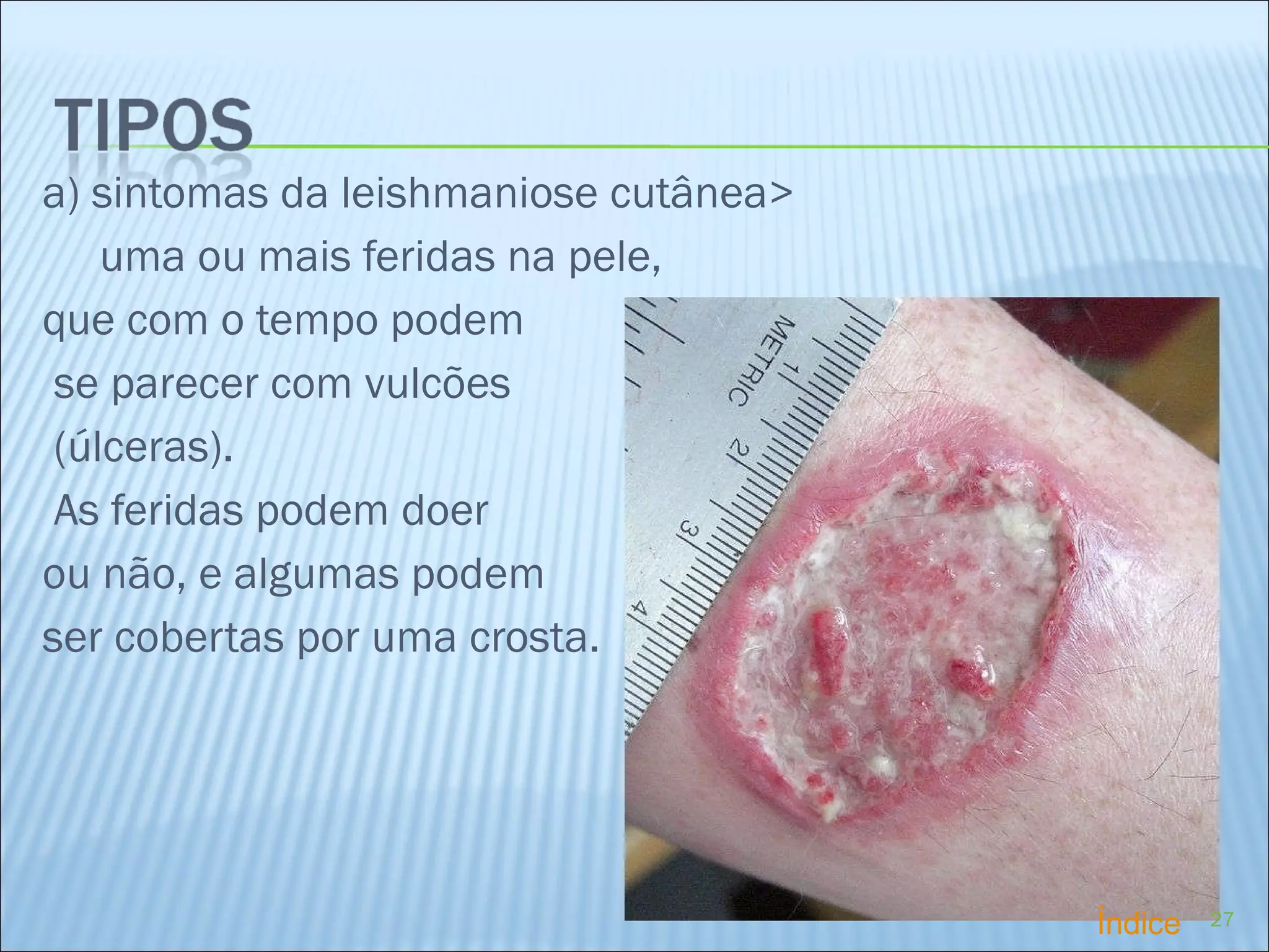 a) sintomas da leishmaniose cutânea> uma ou mais feridas na pele,  que com o tempo podem se parecer com vulcões (úlceras).    As feridas podem doer  ou não, e algumas podem  ser cobertas por uma crosta. Índice 