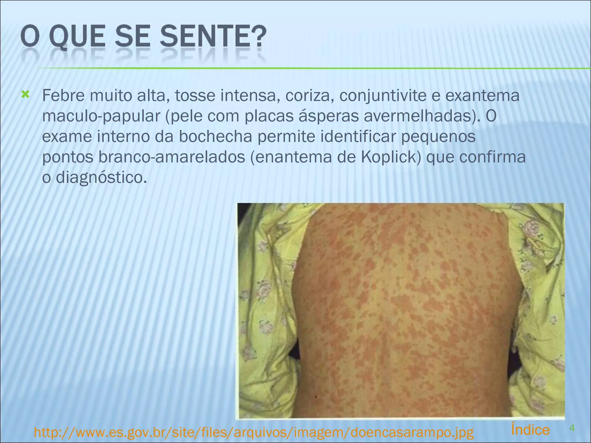 Febre muito alta, tosse intensa, coriza, conjuntivite e exantema maculo-papular (pele com placas ásperas avermelhadas). O exame interno da bochecha permite identificar pequenos pontos branco-amarelados (enantema de Koplick) que confirma o diagnóstico.  http://www.es.gov.br/site/files/arquivos/imagem/doencasarampo.jpg Índice 
