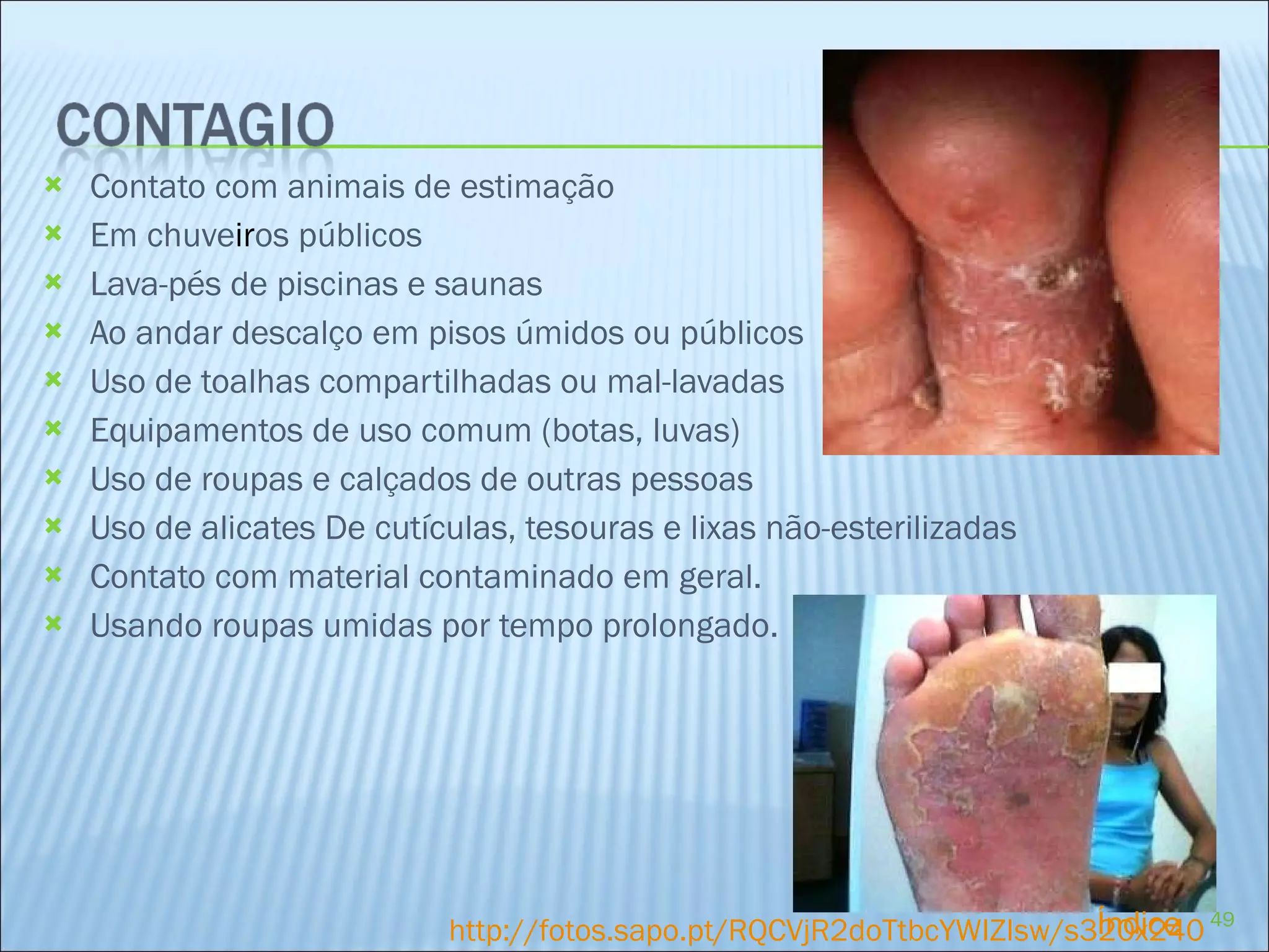 Contato com animais de estimação Em chuve ir os públicos Lava-pés de piscinas e saunas Ao andar descalço em pisos úmidos ou públicos Uso de toalhas compartilhadas ou mal-lavadas Equipamentos de uso comum (botas, luvas) Uso de roupas e calçados de outras pessoas Uso de alicates De cutículas, tesouras e lixas não-esterilizadas Contato com material contaminado em geral. Usando roupas umidas por tempo prolongado. http://fotos.sapo.pt/RQCVjR2doTtbcYWIZIsw/s320x240 Índice 