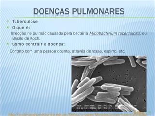 Tuberculose   O que é: Infecção no pulmão causada pela bactéria  Mycobacterium tuberculosis , ou Bacilo de Koch.  Como contrair a doença: Contato com uma pessoa doente, através de tosse, espirro, etc . http://embryology.med.unsw.edu.au/Defect/images/Mycobacterium-tuberculosis.jpg Índice 