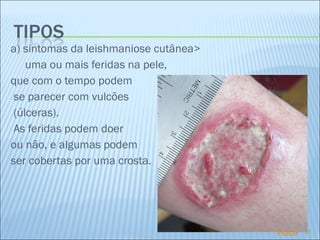 a) sintomas da leishmaniose cutânea> uma ou mais feridas na pele,  que com o tempo podem se parecer com vulcões (úlceras).    As feridas podem doer  ou não, e algumas podem  ser cobertas por uma crosta. Índice 