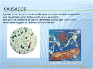 http://www.leprosymission.org.uk/images/about_leprosy/about_leprosy.jpg Mycobacterium leprae  ou bacilo de Hansen é uma actinobactéria, responsável pela hanseníase, nome politicamente correto para lepra. Esta bactéria com forma de bacilo é identificada apenas com uma técnica especialmente agressiva, a técnica de Ziehl-Neelsen . Índice 