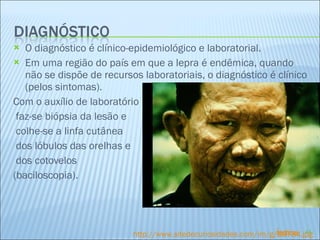 O diagnóstico é clínico-epidemiológico e laboratorial. Em uma região do país em que a lepra é endêmica, quando não se dispõe de recursos laboratoriais, o diagnóstico é clínico (pelos sintomas). Com o auxílio de laboratório faz-se biópsia da lesão e colhe-se a linfa cutânea dos lóbulos das orelhas e dos cotovelos  (baciloscopia). http://www.sitedecuriosidades.com/im/g/B9784.jpg Índice 