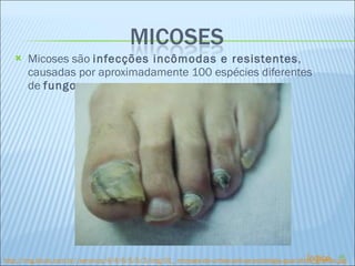 Micoses são  infecções incômodas e resistentes , causadas por aproximadamente 100 espécies diferentes de  fungos ,  http://img.ibiubi.com.br//servicos/4/4/6/5/5/3/img/01_-micoses-de-unhas-poli-pe-podologia-guarulhos_grande.jpg Índice 
