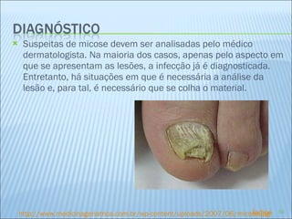 Suspeitas de micose devem ser analisadas pelo médico dermatologista. Na maioria dos casos, apenas pelo aspecto em que se apresentam as lesões, a infecção já é diagnosticada. Entretanto, há situações em que é necessária a análise da lesão e, para tal, é necessário que se colha o material.  http://www.medicinageriatrica.com.br/wp-content/uploads/2007/06/micose.jpg Índice 