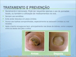 Geralmente é demorado. Pode ser requerido apenas o uso de pomadas locais, ou também a utilização de medicamentos via oral. Sempre use sandálias; Evite andar descalço em pisos úmidos; Nunca use toalhas compartilhadas, especialmente se estiverem úmidas ou mal lavadas; Após o banho enxugue-se bem, principalmente nas áreas de dobras, como o espaço entre os dedos dos pés e virilha http://images.quebarato.com.br/photos/big/4/9/3CA649_2.jpg Índice 