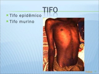 Tifo epidêmico Tifo murino Índice 