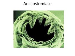 Ancilostomíase 