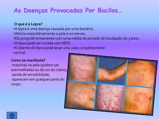 As Doenças Provocadas Por Bacilos…

  O que é a Lepra?
 •A lepra é uma doença causada por uma bactéria.
 •Afecta maioritáriamente a pele e os nervos.
 •Ela progride lentamente com uma média de período de incubação de 3 anos.
 •A lepra pode ser curada com MDT;
 •O doente de lepra pode levar uma vida completamente
 normal.
Como se manifesta?
-manchas na pele (podem ser
avermelhadas ou da cor do cobre);
-perda de sensibilidade;
-aparecem em qualquer parte do
corpo.
 