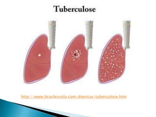 http://www.brasilescola.com/doencas/tuberculose.htm
 