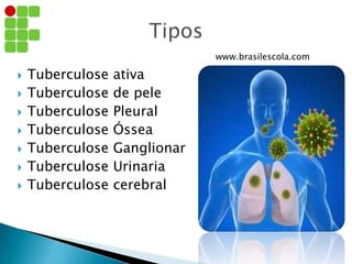  Tuberculose ativa
 Tuberculose de pele
 Tuberculose Pleural
 Tuberculose Óssea
 Tuberculose Ganglionar
 Tuberculose Urinaria
 Tuberculose cerebral
www.brasilescola.com
 