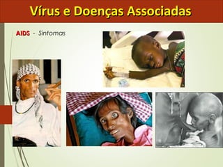 VVíírruuss ee DDooeennççaass AAssssoocciiaaddaass 
AAIIDDSS - Sintomas 
 