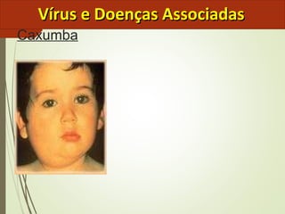 VVíírruuss ee DDooeennççaass AAssssoocciiaaddaass 
Caxumba 
 