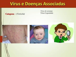 VVíírruuss ee DDooeennççaass AAssssoocciiaaddaass 
CCaattaappoorraa – (Varicela) 
Vírus do sarampo 
Vírus Capsulado 
 