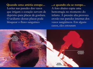Quando uma artéria entope... Lesões nas paredes dos vasos que irrigam o coração servem de depósito para placas de gordura. O acúlumo dessas placas pode bloquear o fluxo sanguíneo  ...e quando ela se rompe... A foto abaixo capta uma hemorragia no momento do infarto. A pressão alta provoca erosão nas paredes internas dos vasos sangüíneos. Em alguns casos, eles estouram  