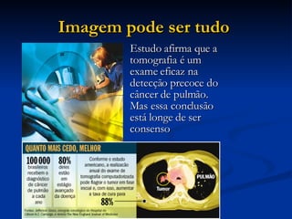 Imagem pode ser tudo   Estudo afirma que a tomografia é um exame eficaz na detecção precoce do câncer de pulmão. Mas essa conclusão está longe de ser consenso  