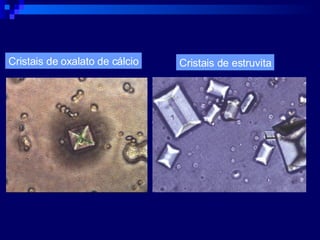 Cristais de oxalato de cálcio Cristais de estruvita 