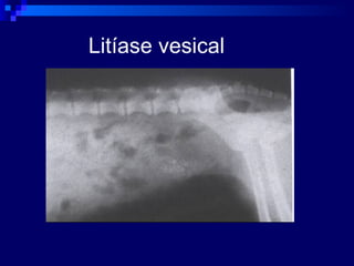 Litíase vesical 