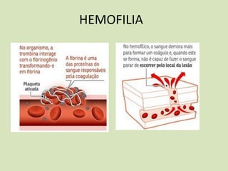 HEMOFILIA
 