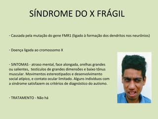 SÍNDROME DO X FRÁGIL
- Causada pela mutação do gene FMR1 (ligado à formação dos dendritos nos neurônios)
- Doença ligada ao cromossomo X
- SINTOMAS - atraso mental, face alongada, orelhas grandes
ou salientes, testículos de grandes dimensões e baixo tônus
muscular. Movimentos estereotipados e desenvolvimento
social atípico, e contato ocular limitado. Alguns indivíduos com
a síndrome satisfazem os critérios de diagnóstico do autismo.
- TRATAMENTO - Não há
 