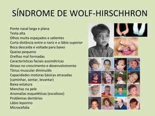 SÍNDROME DE WOLF-HIRSCHHRON
Ponte nasal larga e plana
Testa alta
Olhos muito espaçados e salientes
Curta distância entre o nariz e o lábio superior
Boca descaída e voltada para baixo
Queixo pequeno
Orelhas mal formadas
Características faciais assimétricas
Atraso no crescimento e desenvolvimento
Tônus muscular diminuído
Capacidades motoras básicas atrasadas
(caminhar, sentar, levantar)
Baixa estatura
Manchas na pele
Anomalias esqueléticas (escoliose)
Problemas dentários
Lábio leporino
Microcefalia
 