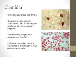 Clamídia
• Uretrite não gonocócica (UNG);
• O patógeno mais comum
associado à UNG é a Chlamydia
trachomatis, um coco gram
negativo;
• Ureaplasma urealyticum e
Mycoplasma hominis;
• Estima-se que seja a doença
sexualmente transmissível mais
comum no mundo.
 