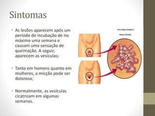 Sintomas
• As lesões aparecem após um
período de incubação de no
máximo uma semana e
causam uma sensação de
queimação. A seguir,
aparecem as vesículas;
• Tanto em homens quanto em
mulheres, a micção pode ser
dolorosa;
• Normalmente, as vesículas
cicatrizam em algumas
semanas.
 
